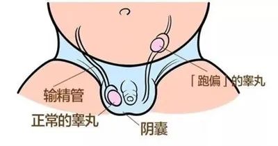 科普 | 蛋蛋也会“捉迷藏”？宝宝睾丸隐匿腹腔，家长要紧急寻找