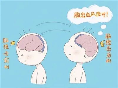 科普 | 哄宝宝只需摇一摇？当心摇晃婴儿综合征
